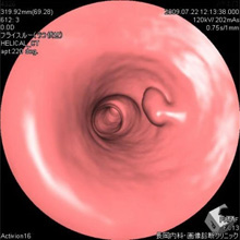 大腸ポリープの仮想内視鏡画像