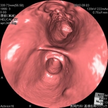 胃がんの仮想内視鏡画像