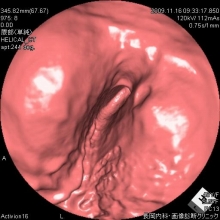 胃潰瘍の仮想内視鏡画像
