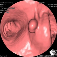 大腸ポリープ（腺腫）仮想内視鏡画像
