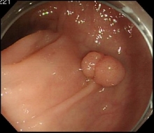 大腸ポリープ（腺腫）内視鏡写真