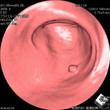 大腸ポリープ（腺腫）仮想内視鏡画像