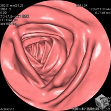表在型大腸扁平腺腫仮想内視鏡画像
