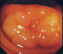 表在型大腸扁平腺腫内視鏡写真