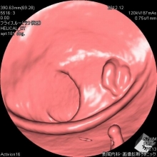 表在型大腸がん仮想内視鏡画像
