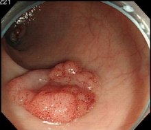 表在型大腸がん内視鏡写真