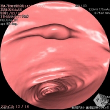 表在型大腸がん仮想内視鏡画像