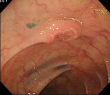 表在型大腸がん内視鏡写真
