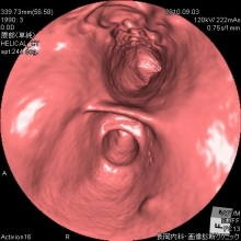早期胃がん仮想内視鏡画像
