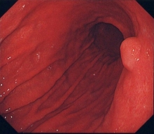 早期胃がん内視鏡写真
