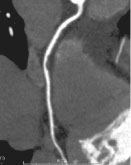 冠動脈CT検査画像