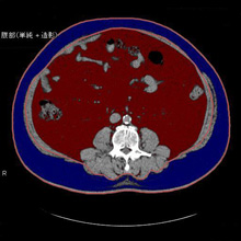 内臓脂肪優位型メタボリックシンドロームのCT画像