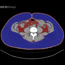 皮下脂肪優位型メタボリックシンドロームのCT画像