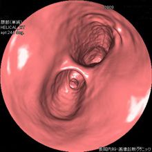 仮想内視鏡検査画像